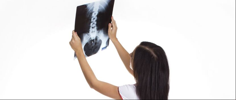 Las fracturas son, sin duda, la principal consecuencia de la osteoporosis. (Foto: Archivo/ GFR Media)